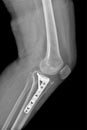 Radiography of the operated Tibia, in a patient after an accident Royalty Free Stock Photo