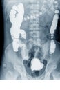 Radiological examination to look for colon abnormalities By enema the barium powder and air into the anus.