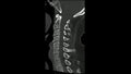 Computed Tomography examination of the Cervical spine  CT CS sagittal in cine mode Royalty Free Stock Photo