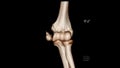 Radiology examination, Computed Tomography Volume Rendering examination of the Elbow joint