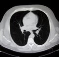 Radiology, MSCT (computed body tomography)of chest