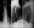 X-ray of the upper gastrointestinal series UGI with barium. Cancer of the esophagus.