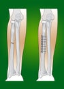 Radius fracture surgical intervention