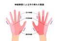 Range of hand numbness due to neurological disorders