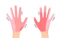 Range of hand numbness due to neurological disorders