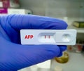 Rapid diagnostic test for AFP test (liver cancer diagnosis) with a positive result Royalty Free Stock Photo