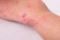 Rash on a child leg  on white background, redness, allergic reaction, dermatitis symptom Royalty Free Stock Photo