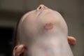 rash on the child& x27;s chin in the form of pimples in a circle staphylococcus
