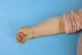 rash on the crease of a child& x27;s arm close-up, atopic dermatitis, or food allergy Royalty Free Stock Photo