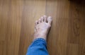 rash eczema on woman skin foot
