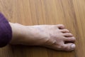rash eczema on woman skin foot