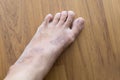 rash eczema on woman skin foot