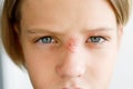 Rash on the face of a child, on the nose and eye, close-up: herpes, virus, infection, conjunctivitis, allergy - medical concept Royalty Free Stock Photo