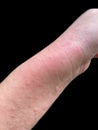 Rash on forearm of Asian female patient Royalty Free Stock Photo