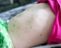 A rash on the skin of the abdomen in a child infectious disease chickenpox, infection