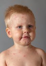 Rashes in the boy with chickenpox, on gray