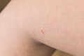 Rashes on skin Royalty Free Stock Photo