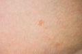 Rashes on the skin Royalty Free Stock Photo