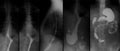 X-ray of the upper gastrointestinal tract UGI with barium. Hiatal hernia.