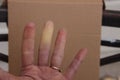 Raynaud Raynaud& x27;s syndrome phenomenon in adult hand