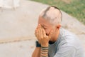 Real alopecia areata in a young girl. A bald head in a person. Diffuse alopecia Royalty Free Stock Photo