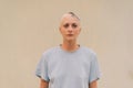 Real alopecia areata in a young girl. A bald head in a person. Diffuse alopecia Royalty Free Stock Photo