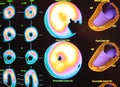 myocardial ischemia nuclear medicine