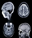 A real MRI/ MRA (Magnetic Resonance Angiogram) of