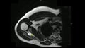 Real MRI Scan of Doctor examining male shoulder and finding a lesion, an oedema and the very rare paraglenodiale Cyst