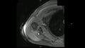 Real MRI Scan of Doctor examining male shoulder and finding a lesion, an oedema and the very rare paraglenodiale Cyst