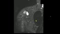 Real MRI Scan of Doctor examining male shoulder and finding a lesion, an oedema and the very rare paraglenodiale Cyst