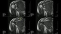 Real MRI Scan of Doctor examining male shoulder and finding a lesion, an oedema and the very rare paraglenodiale Cyst