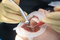 real. dentist treats patient with caries, drills tooth and installs filling