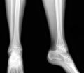 Real x-rays of the healthy lower leg - front and side view Royalty Free Stock Photo