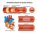 Realistic Atherosclerosis Infographic Royalty Free Stock Photo