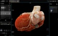 Realistic 3D Heart CTA Scan:.A detailed CTA scan showing the coronary arteries and heart structure, providing a comprehensive view