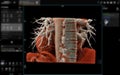 Realistic 3D Heart CTA Scan:.A detailed CTA scan showing the coronary arteries and heart structure, providing a comprehensive view