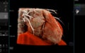 Realistic 3D Heart CTA Scan:.A detailed CTA scan showing the coronary arteries and heart structure, providing a comprehensive view