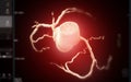Realistic 3D Heart CTA Scan:.A detailed CTA scan showing the coronary arteries and heart structure, providing a comprehensive view