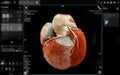 Realistic 3D Heart CTA Scan:.A detailed CTA scan showing the coronary arteries and heart structure, providing a comprehensive view