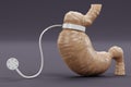 3D Render of Stomach with Gastric Band