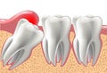 Realistic 3D teeth, and wisdom tooth problems