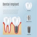 Realistic Dental Implant Infographics Royalty Free Stock Photo