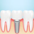 Realistic Dental Implant. Installation Of Dental Implant With All Parts Crown, Abutment, On A Background Royalty Free Stock Photo