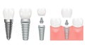 Realistic dental implant structure with all parts crown, abutment, screw. Dentistry. Implantation of human teeth. Vector