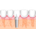 Dental implant with all parts: crown, abutment, screw. Healthy teeth and dental implant. Dentistry. Implantation of human teeth. V