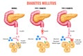 Realistic Diabetes Mellitus Infographics
