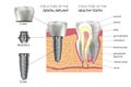 Realistic healthy tooth and structure, dental implant with all parts: crown, abutment, screw. Royalty Free Stock Photo