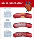 Realistic Heart Infographic Surgery Therapy Banner
