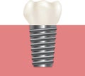 Realistic Human Dental Implant. Vector
